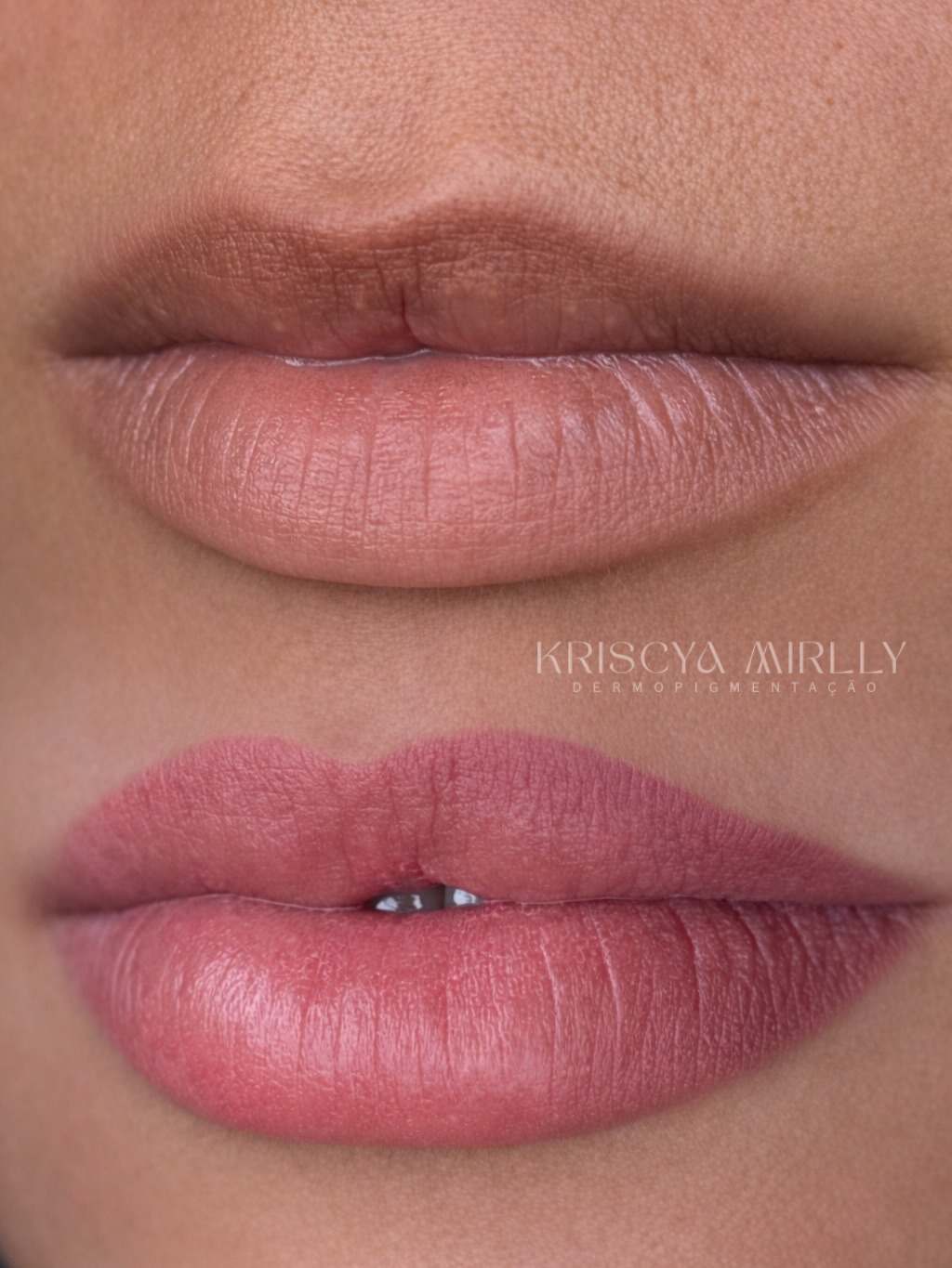 Resultado Procedimento Labial