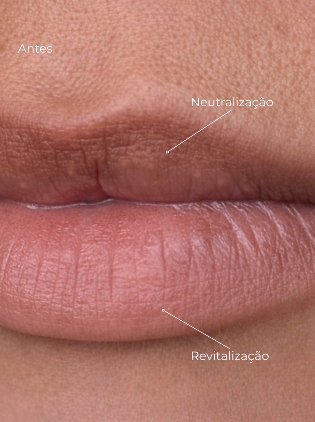 Resultado Procedimento Labial
