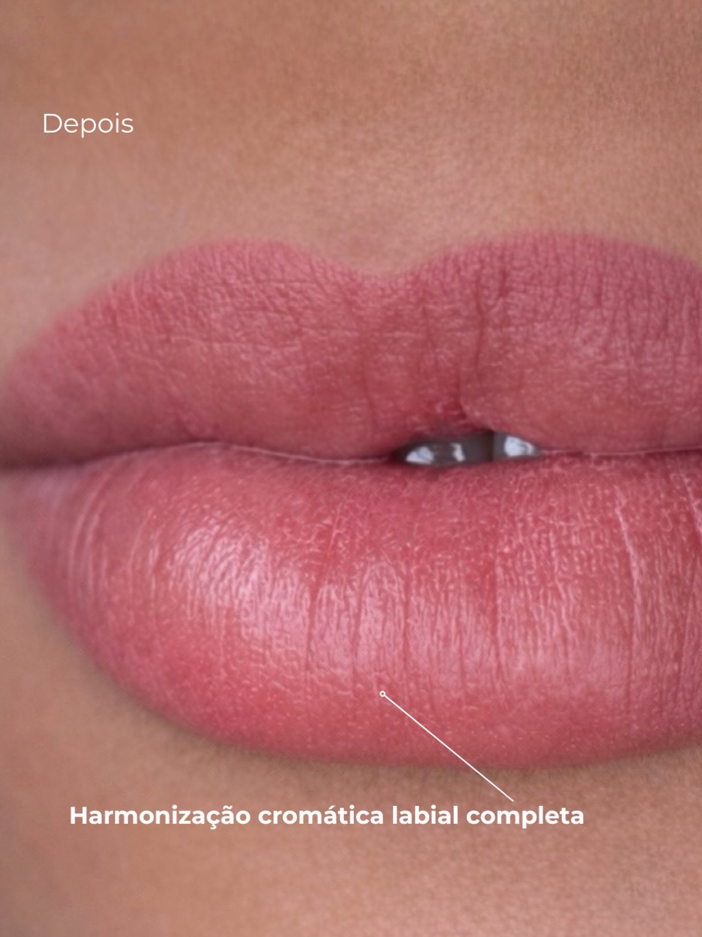 Resultado Procedimento Labial