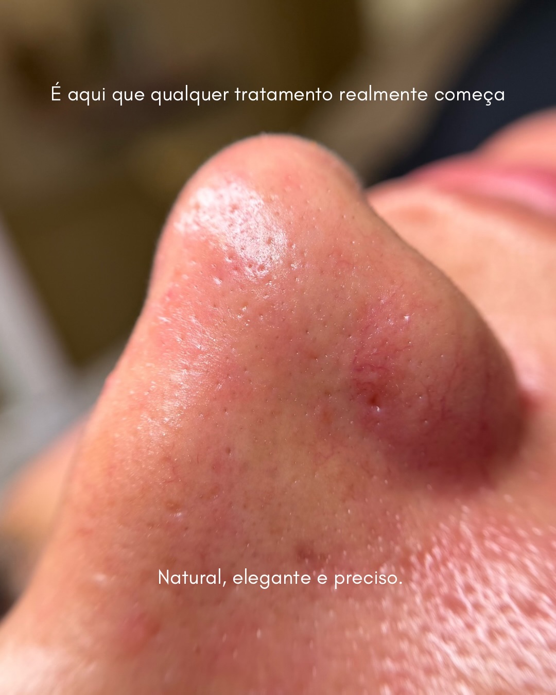 Resultado Limpeza de Pele
